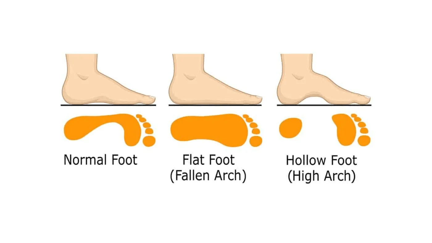 Flat Feet in Children – Should Parents Be Concerned?
