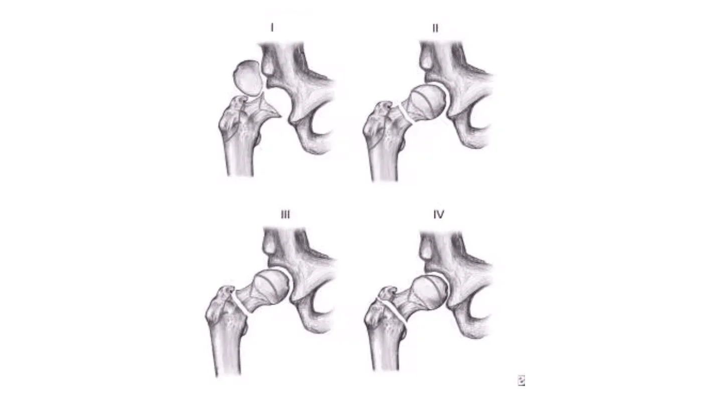 Fractures in Children – Can They Affect Future Growth?