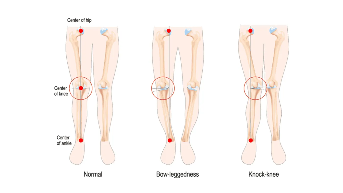 Knock Knees and Bow Legs in Children – When to Worry?