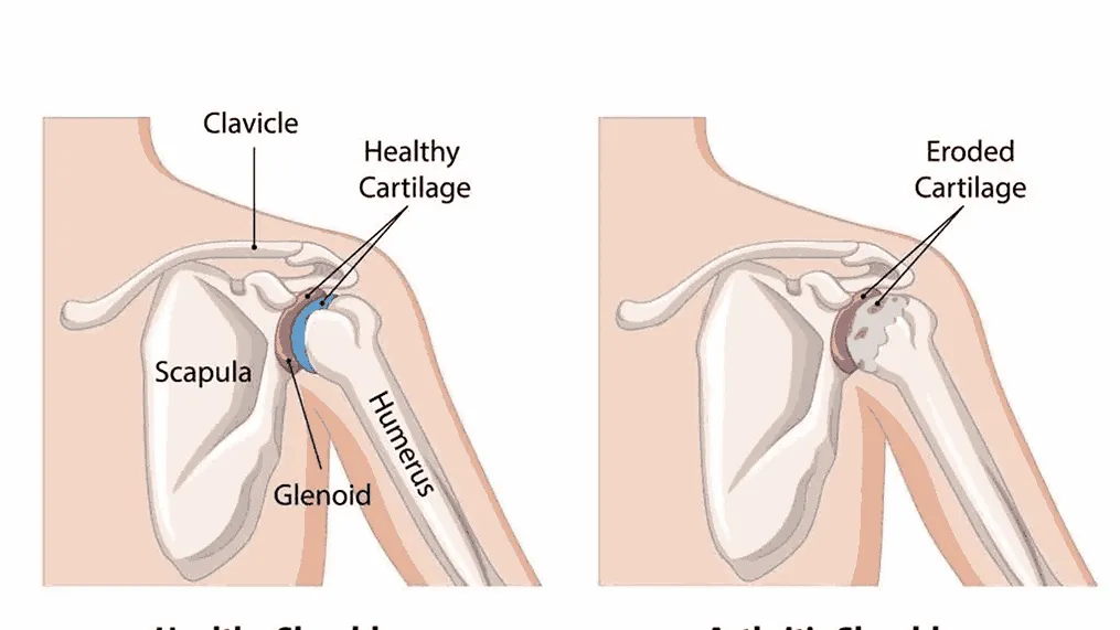 Role of Early Intervention in Preventing Long-Term Bone Issues