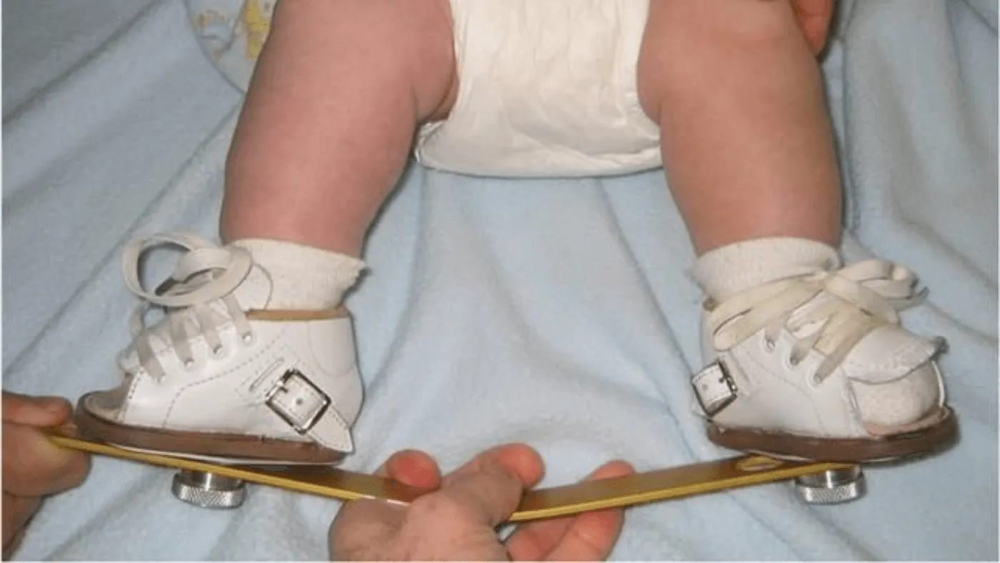 Clubfoot in Infants: Modern Treatment Options That Work