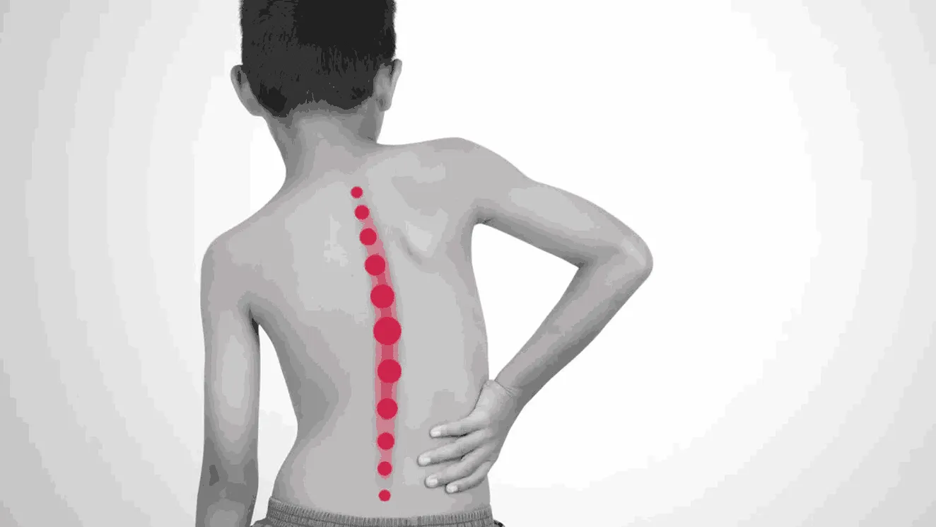 Scoliosis in Kids: Warning Signs Parents Shouldn’t Ignore
