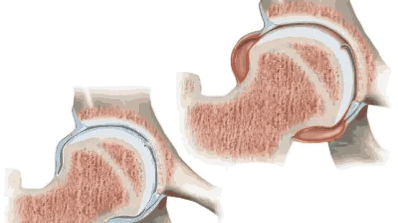 Limping in Children: Common Causes and When to See a Doctor