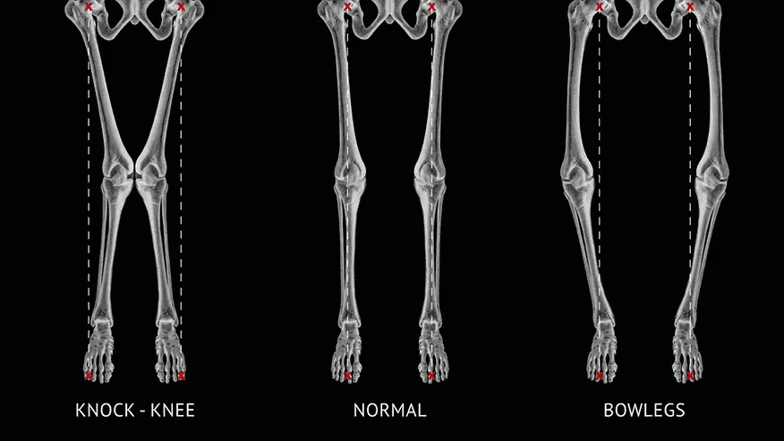 Knock Knees and Bow Legs: What’s Normal and What’s Not?