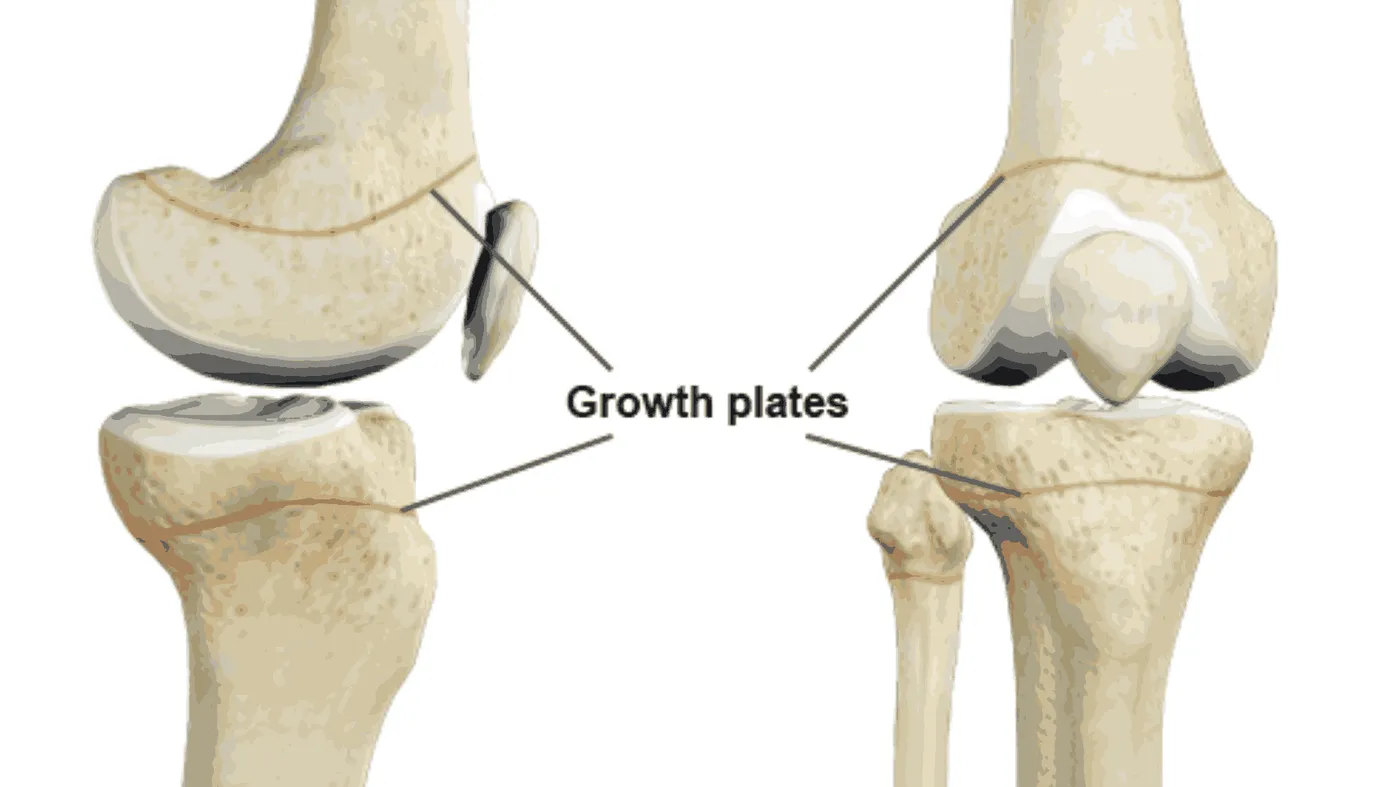 Understanding Growth Plate Injuries – Impact on Future Height