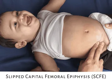 Early Treatment for Clubfoot: Why It Matters