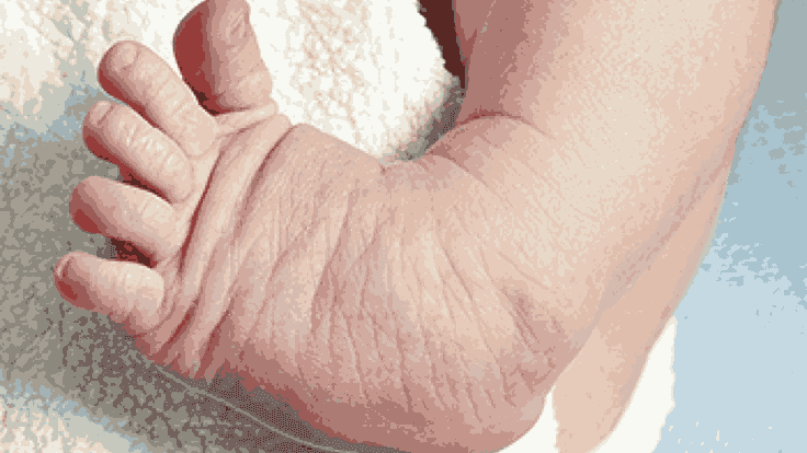 Clubfoot in Newborns: Early Detection and Treatment Options