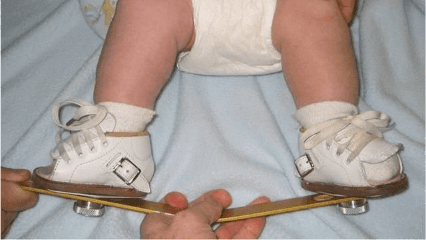 Clubfoot in Infants: Modern Treatment Options That Work