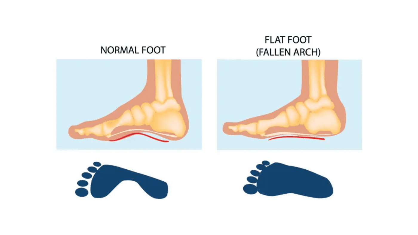 Flat Feet in Children: What’s Normal and When to Seek Help?