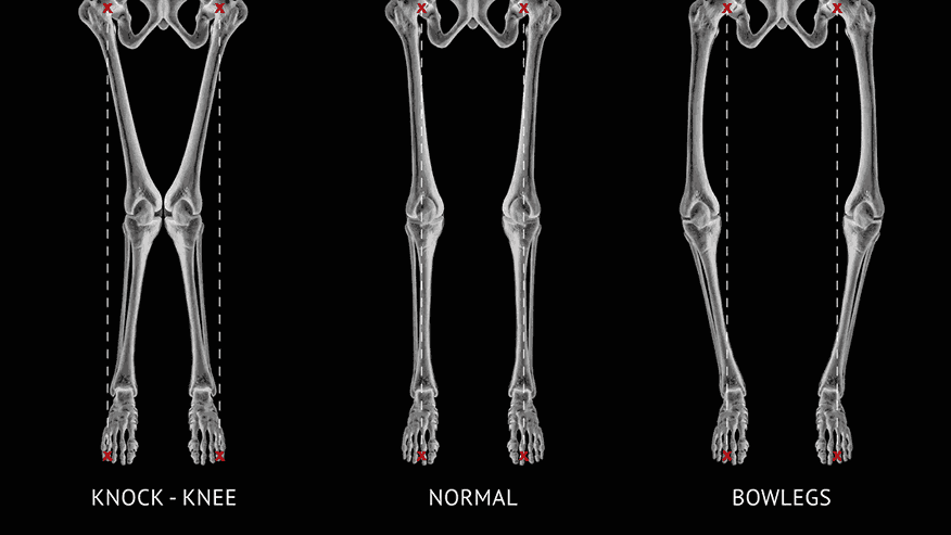Knock Knees and Bow Legs: What’s Normal and What’s Not?