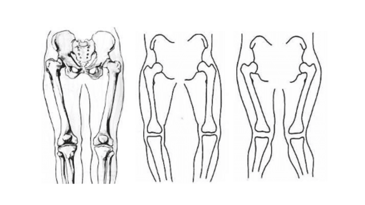 Bow Legs vs. Knock Knees in Children: What’s Normal and What’s Not?
