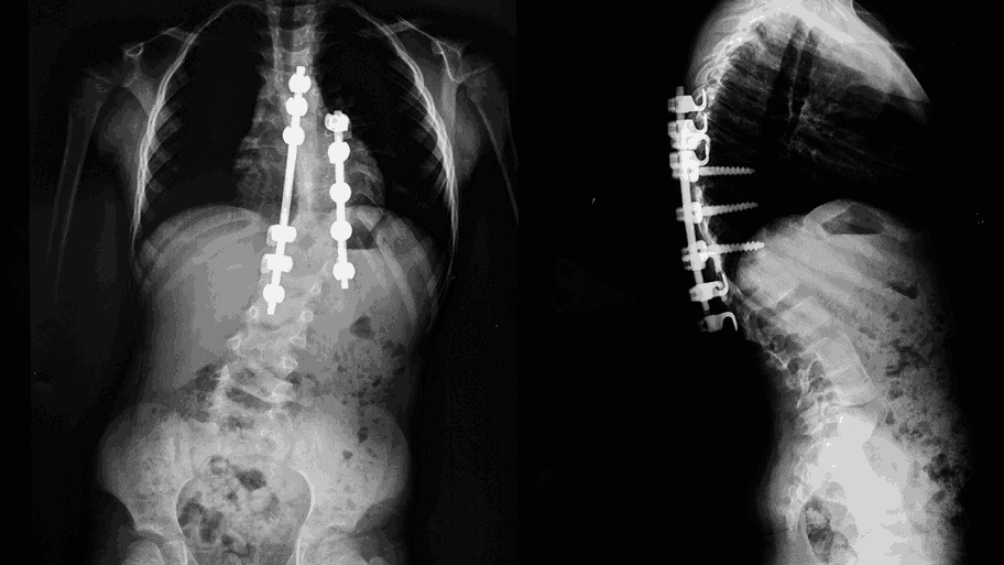 Early Signs and Care for Pediatric Scoliosis