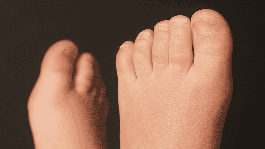 Is Your Child’s Clubfoot Coming Back?