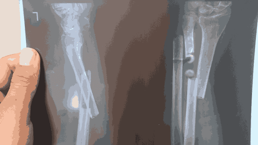 Fractures in Children – Why They Heal Faster but Need Care
