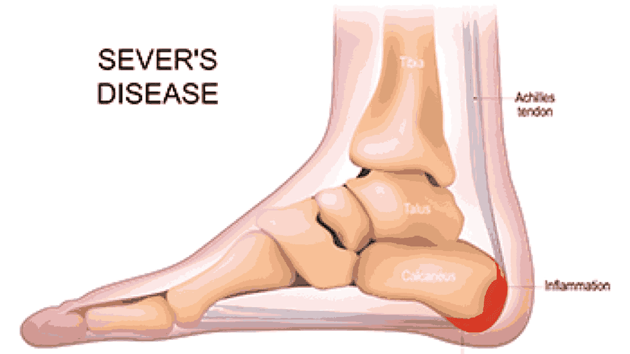 Growth Plate Injuries – Causes, Symptoms, and Recovery