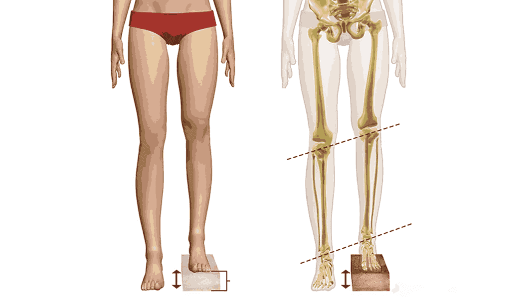 Limb Length Discrepancy – Causes, Detection, and Treatment