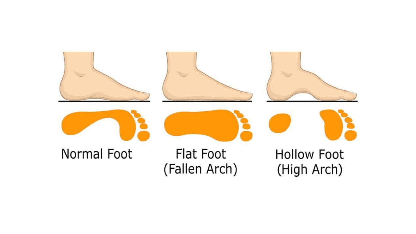 Flat Feet in Children – Should Parents Be Concerned?