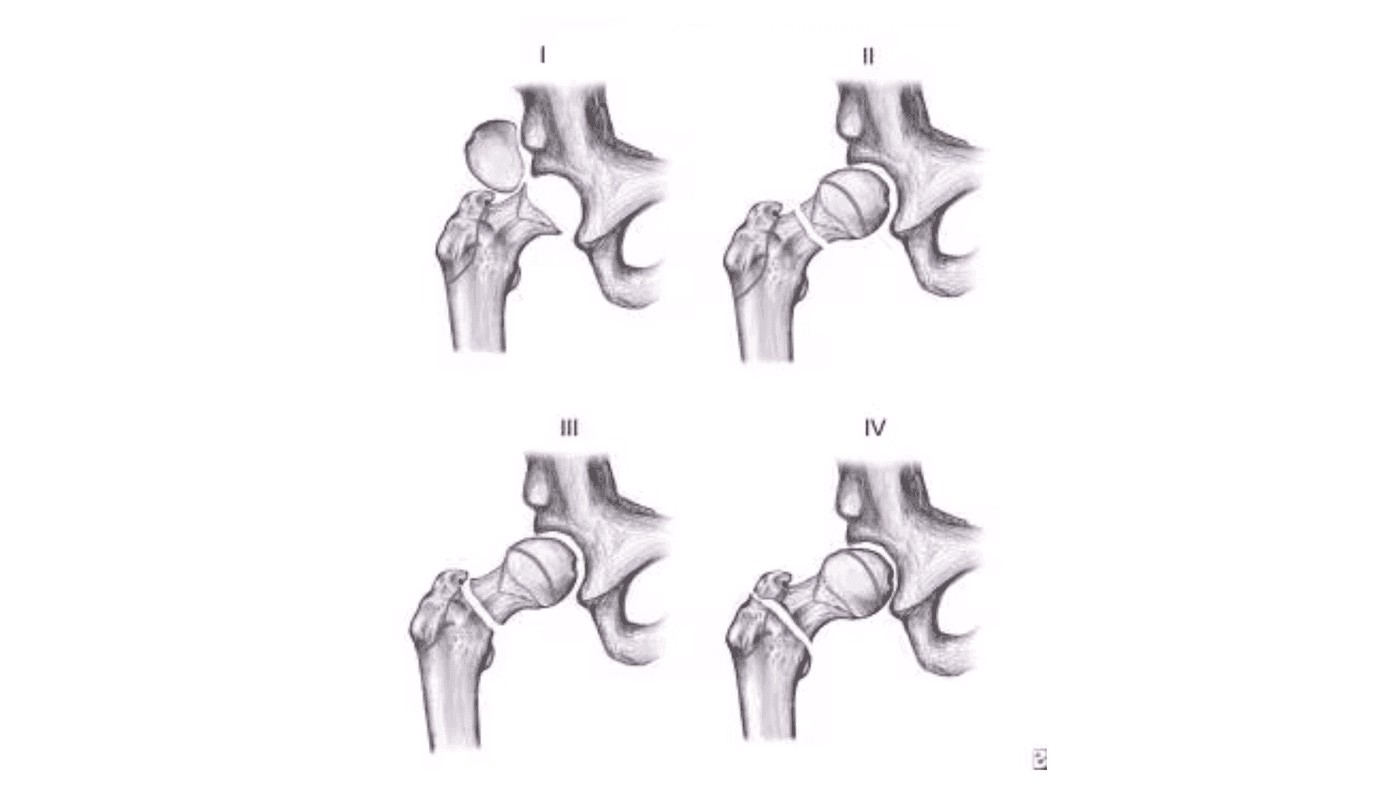 Fractures in Children – Can They Affect Future Growth?