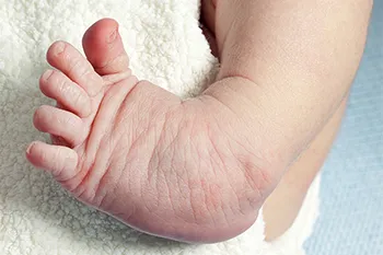 Best Clubfoot Treatment in Shimla