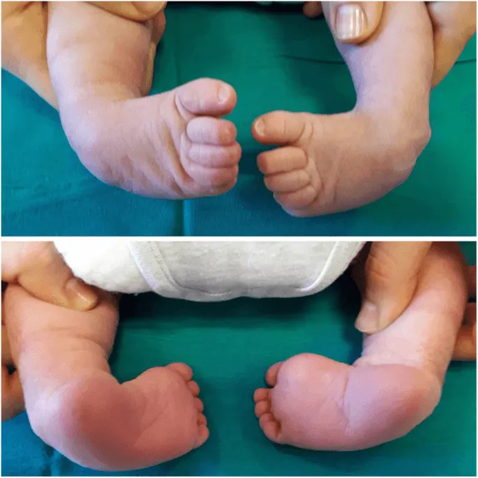 CTEV Treatment in Noida