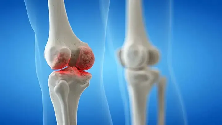 Bone Infection Treatment Doctor in Delhi
