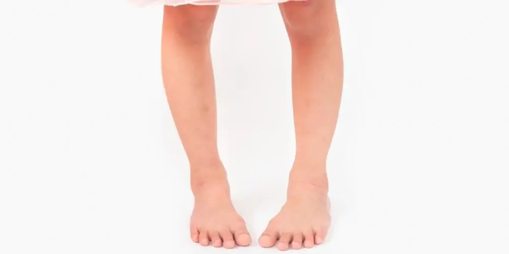 Best Bow Legs Treatment Doctor in Faridabad
