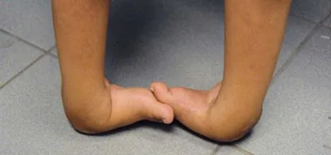 Best Clubfoot Treatment in Amritsar
