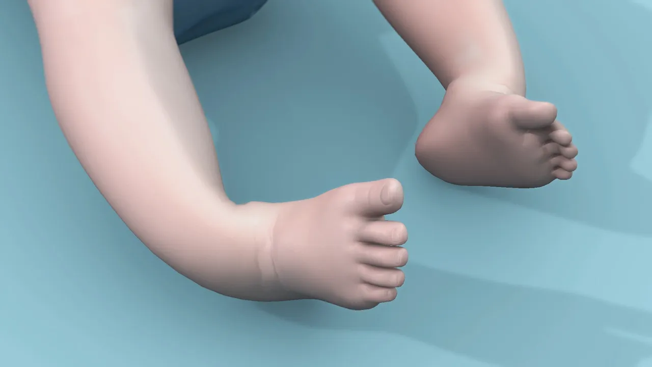 Best Clubfoot Treatment in Ludhiana
