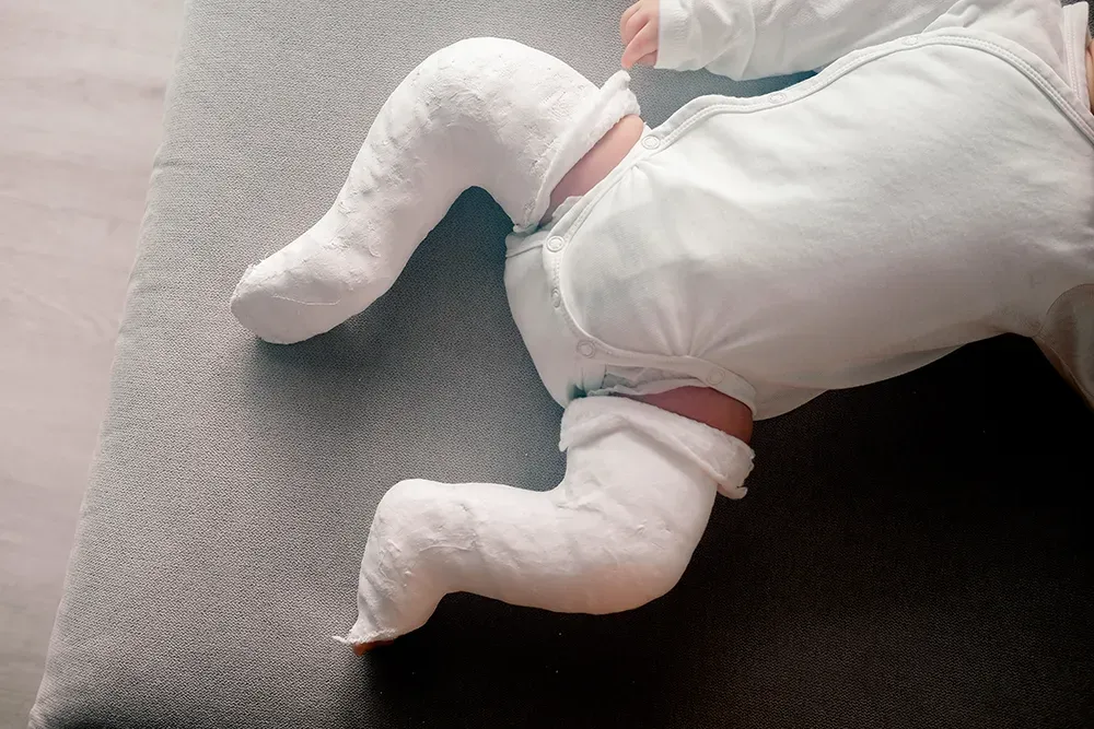 Best Clubfoot Treatment in Karnal