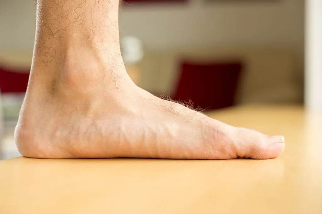 Flat Foot Treatment Doctors in Delhi