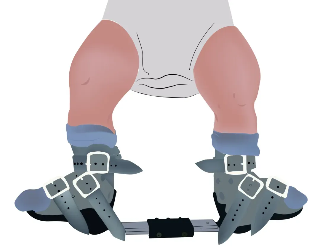 Clubfoot Surgeon in Gurgaon