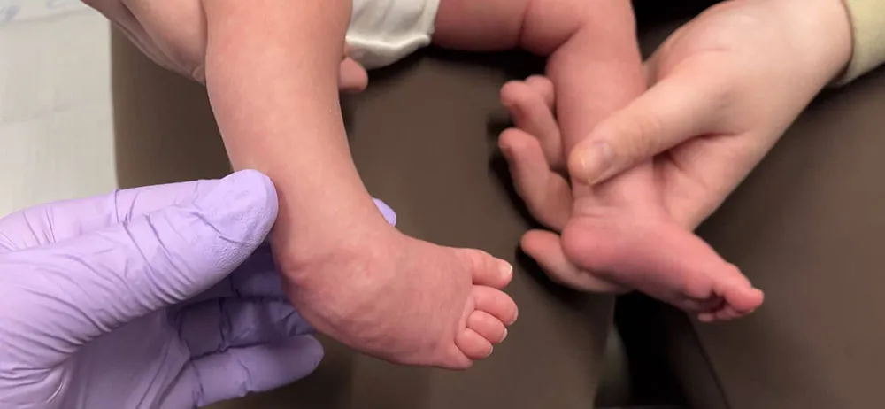 Best Clubfoot Treatment in Patna