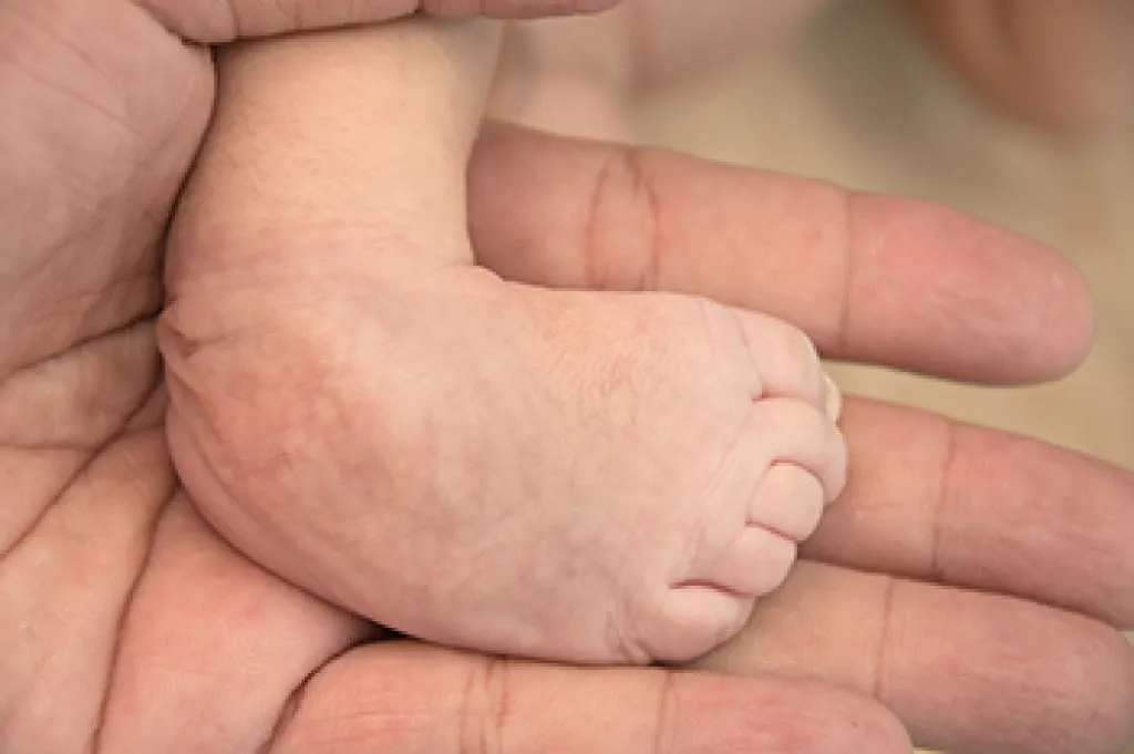 Best Clubfoot Treatment in Jaipur