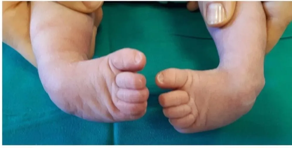 Best Clubfoot Treatment in Rohtak