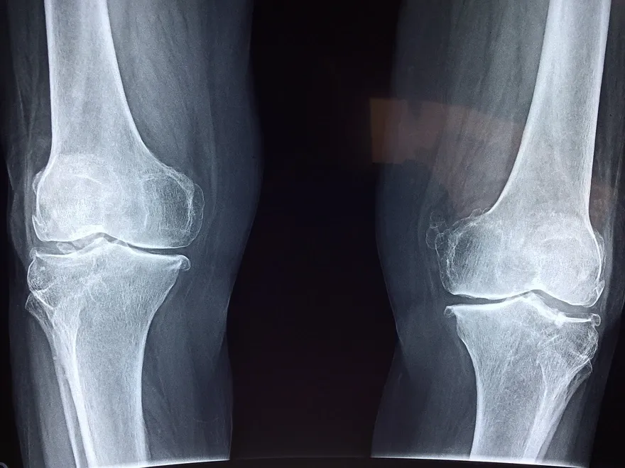 Bone Infection Treatment Doctor in Noida