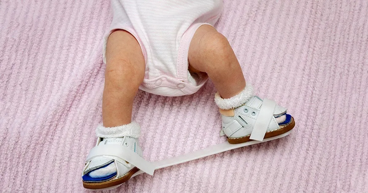 Best Clubfoot Treatment in Noida