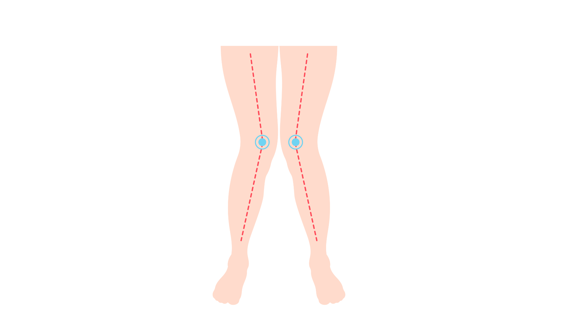 Bowlegs and. Knock Knees: What’s Normal & When to See a Doctor?