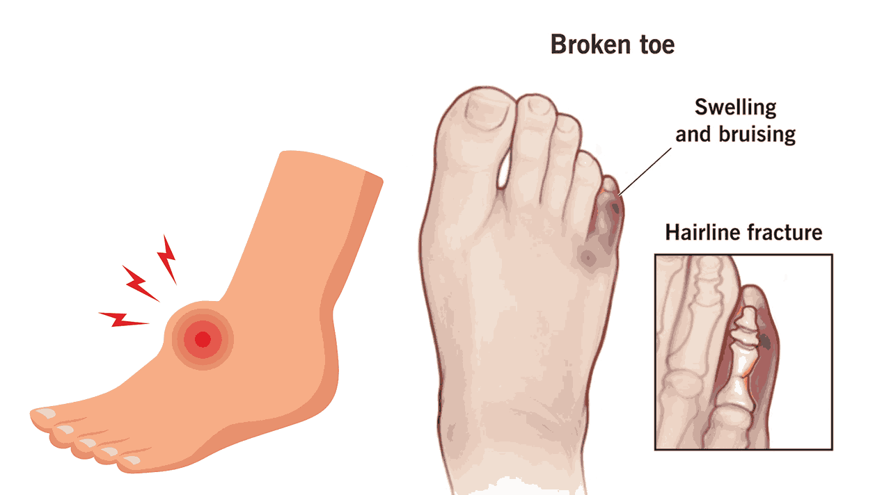 Stubbed Toe or Something More? Understanding Foot Injuries in Children.
