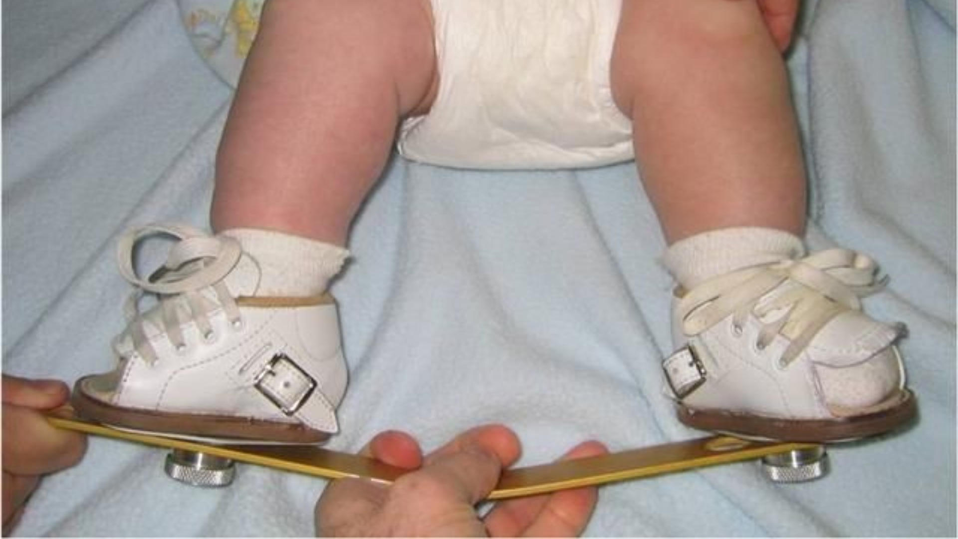 Clubfoot in Infants: Modern Treatment Options That Work