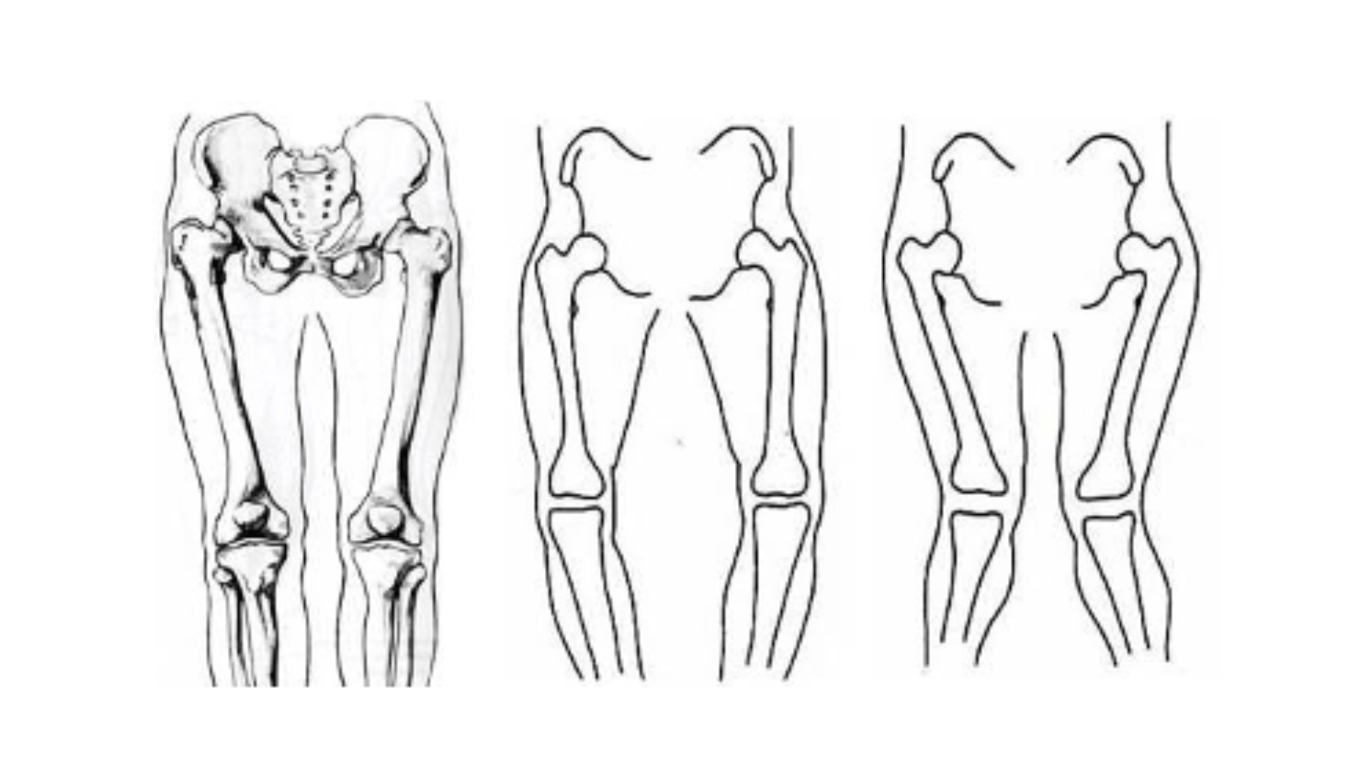 Bow Legs vs. Knock Knees in Children: What’s Normal and What’s Not?
