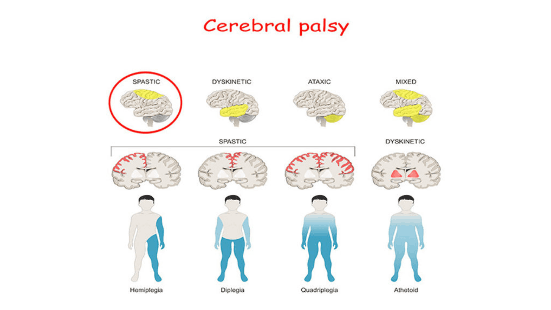 Early Signs of Cerebral Palsy: How to Spot Developmental Delays