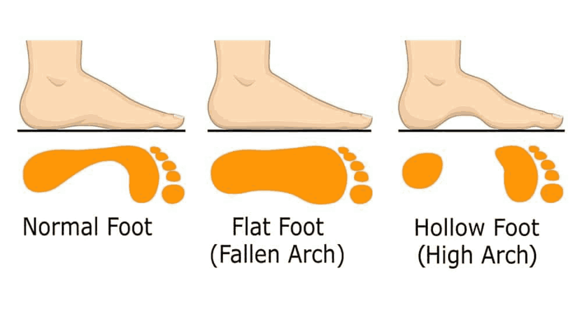 When to Worry About Flat Feet in Children