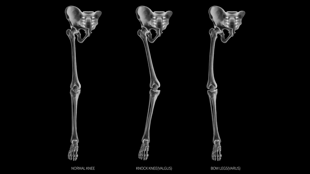 Knock Knees vs. Bow Legs – Understanding the Difference
