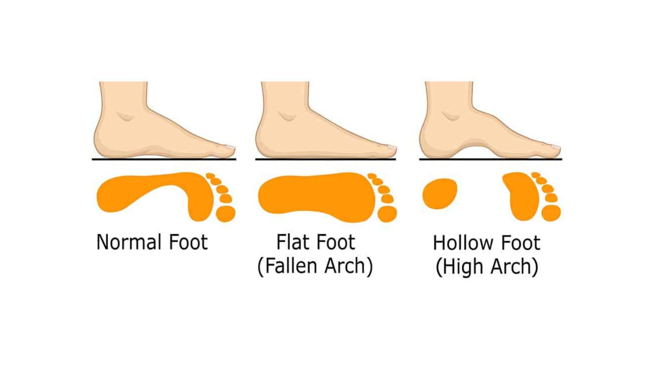 Flat Feet in Children – Should Parents Be Concerned?