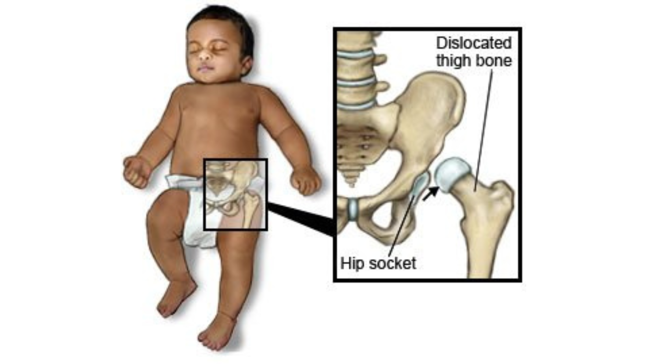Hip Disorders in Children – Symptoms Parents Should Never Ignore