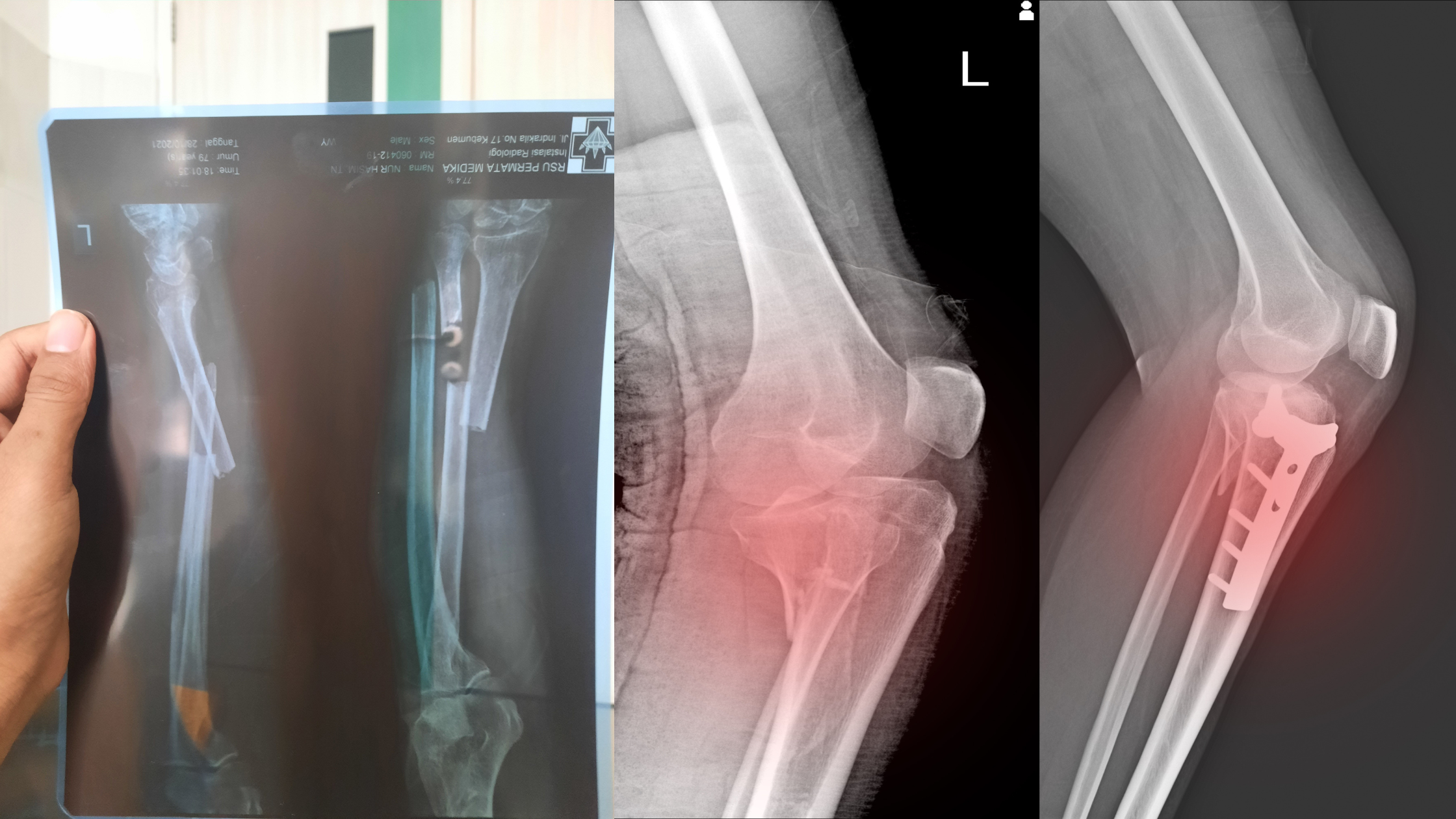 Post-Fracture Care – Helping Your Child Heal and Regain Strength