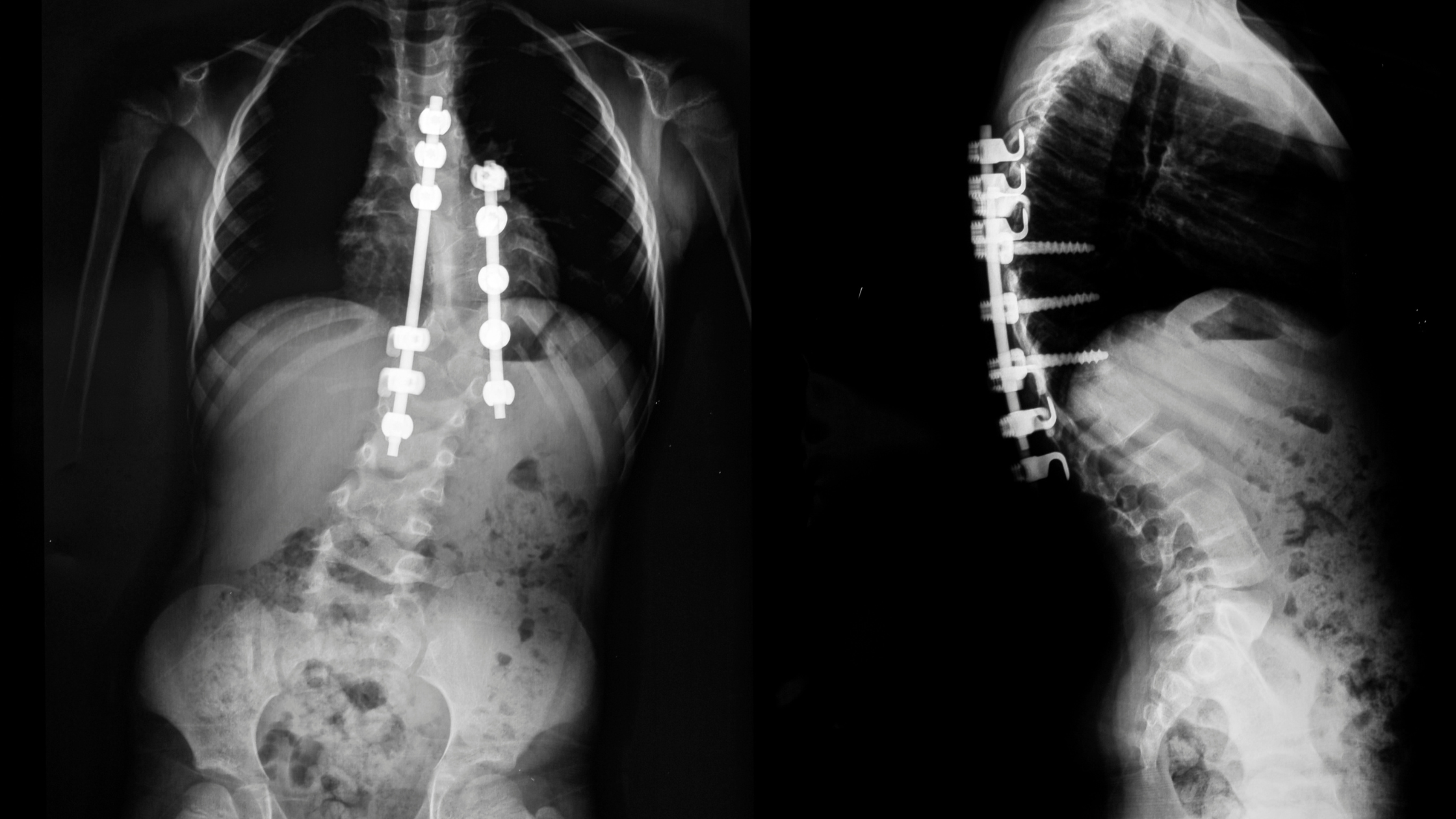 Scoliosis in Children – How to Identify the Early Signs