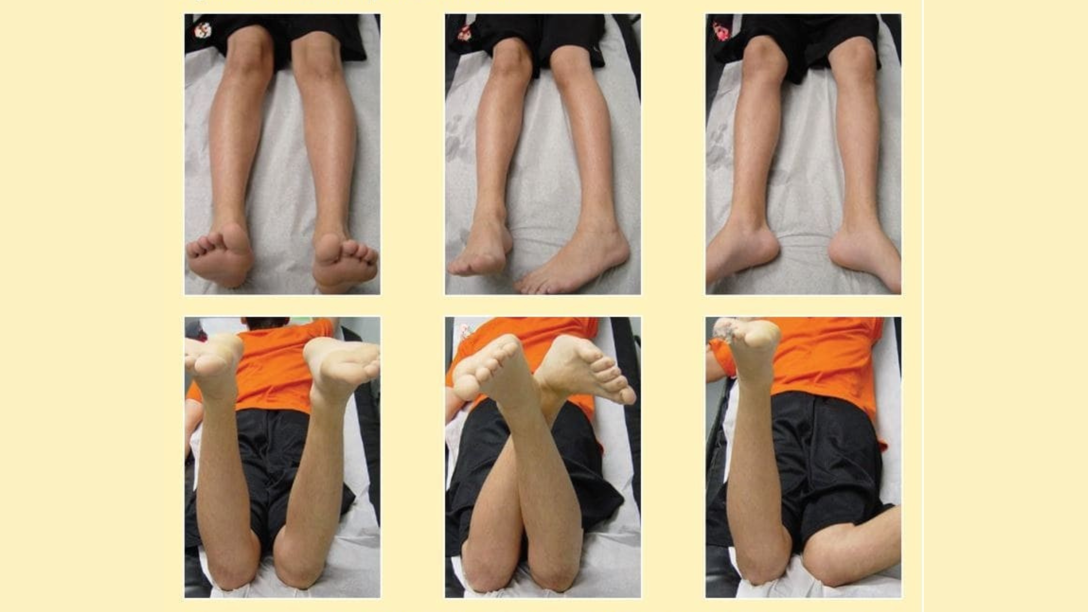 When to Worry About Your Child’s Limp – Normal or Concerning?