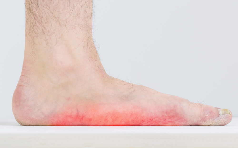 Flat Foot Treatment Doctors in Noida