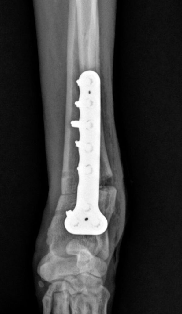 Limb Deformity Correction Surgery in Faridabad